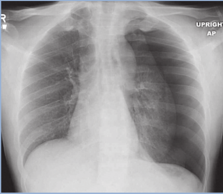 Imagem de Rx de tórax com pneumotórax
