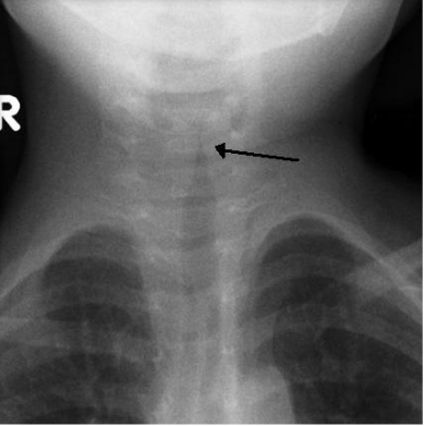 Imagem de Rx de pescoço com sinal da torre